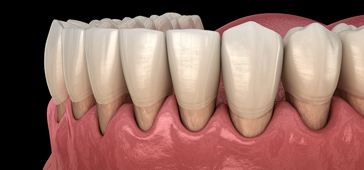 Can a Night Guard Cause Gum Recession