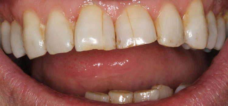 Craze Lines In Teeth - Pro Teeth Guard